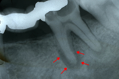 むし歯の治療例