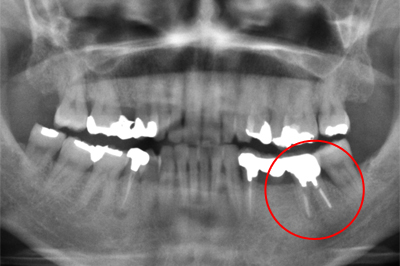 むし歯の治療例