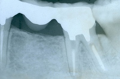 むし歯の治療例