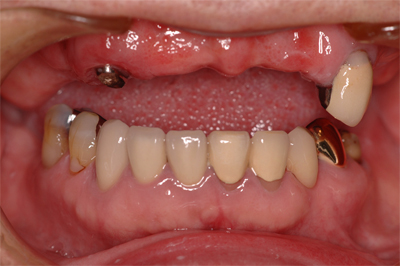 入れ歯の治療例