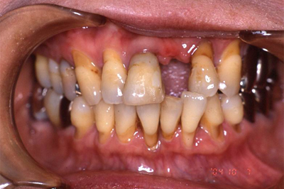 インプラント施術例
