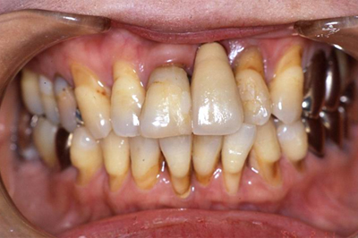 インプラント施術例